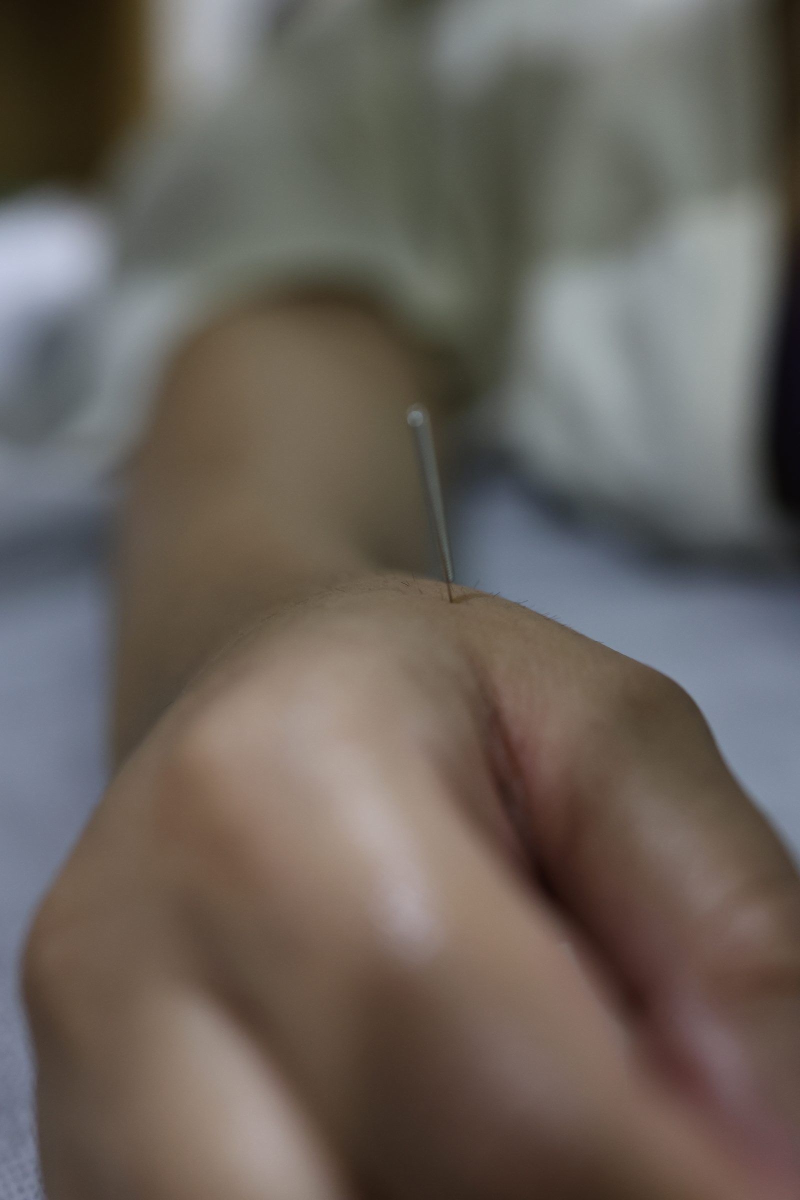 Acupuncture therapy